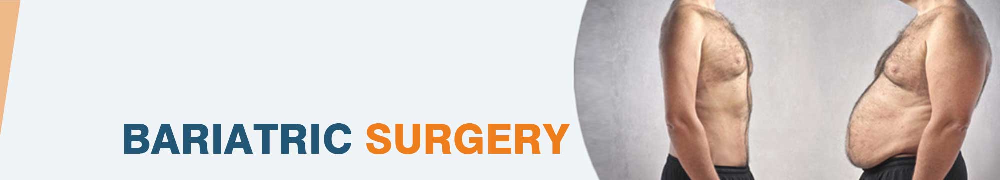 weight loss surgery in india