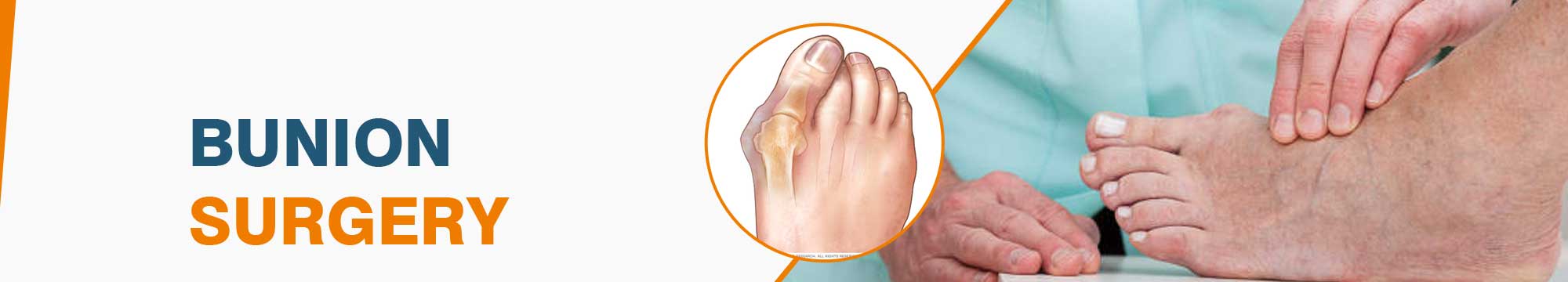 Bunion Surgery in India
