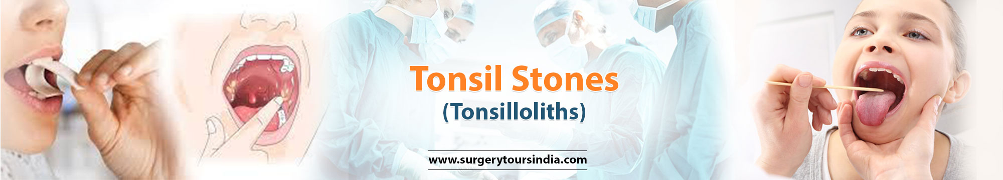guide to tonsil stones treatment india