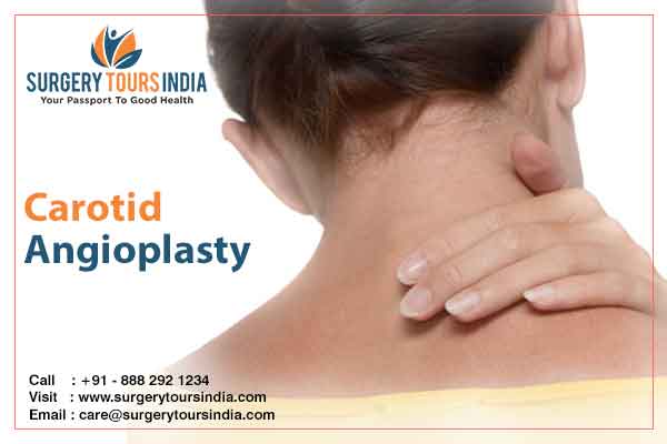Carotid Angioplasty India
