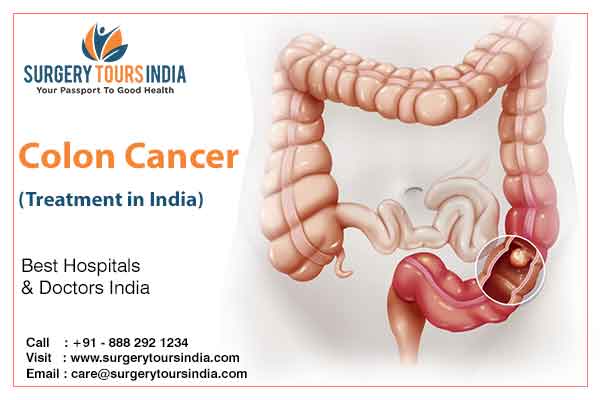 Colon Cancer treatment In India
