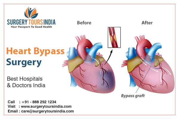 Heart Bypass Surgery India