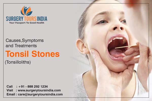 guide to tonsil stones treatment india