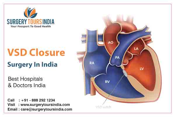 VSD Closure Surgery India