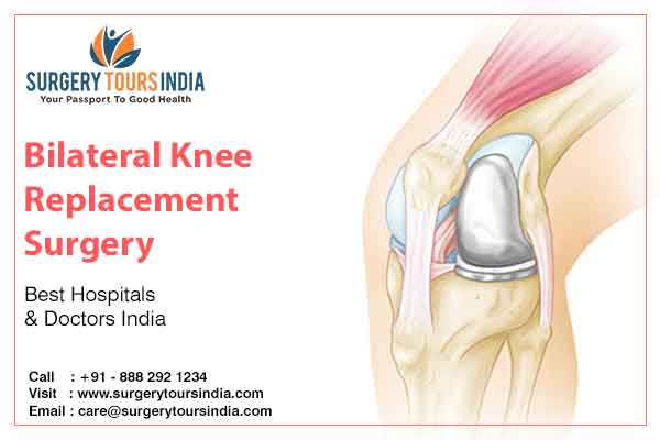 Bilateral Total Knee Replacement India