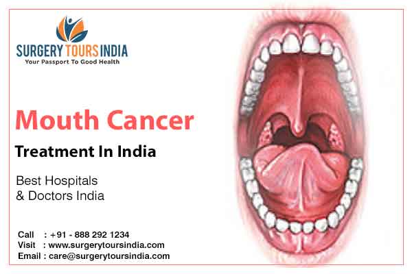Mouth Cancer: Its Signs, Types and Surgery Options In India