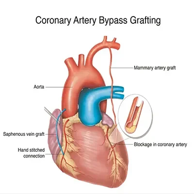 Coronary Artery Bypass Coronary Artery Bypass
