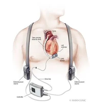 Heart Transplant Heart Transplant