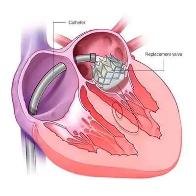 Heart Valve Replacement Heart Valve Replacement